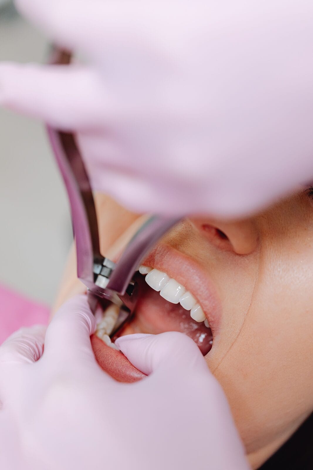 Dentiste réalisant une extraction dentaire à l'aide d'un davier