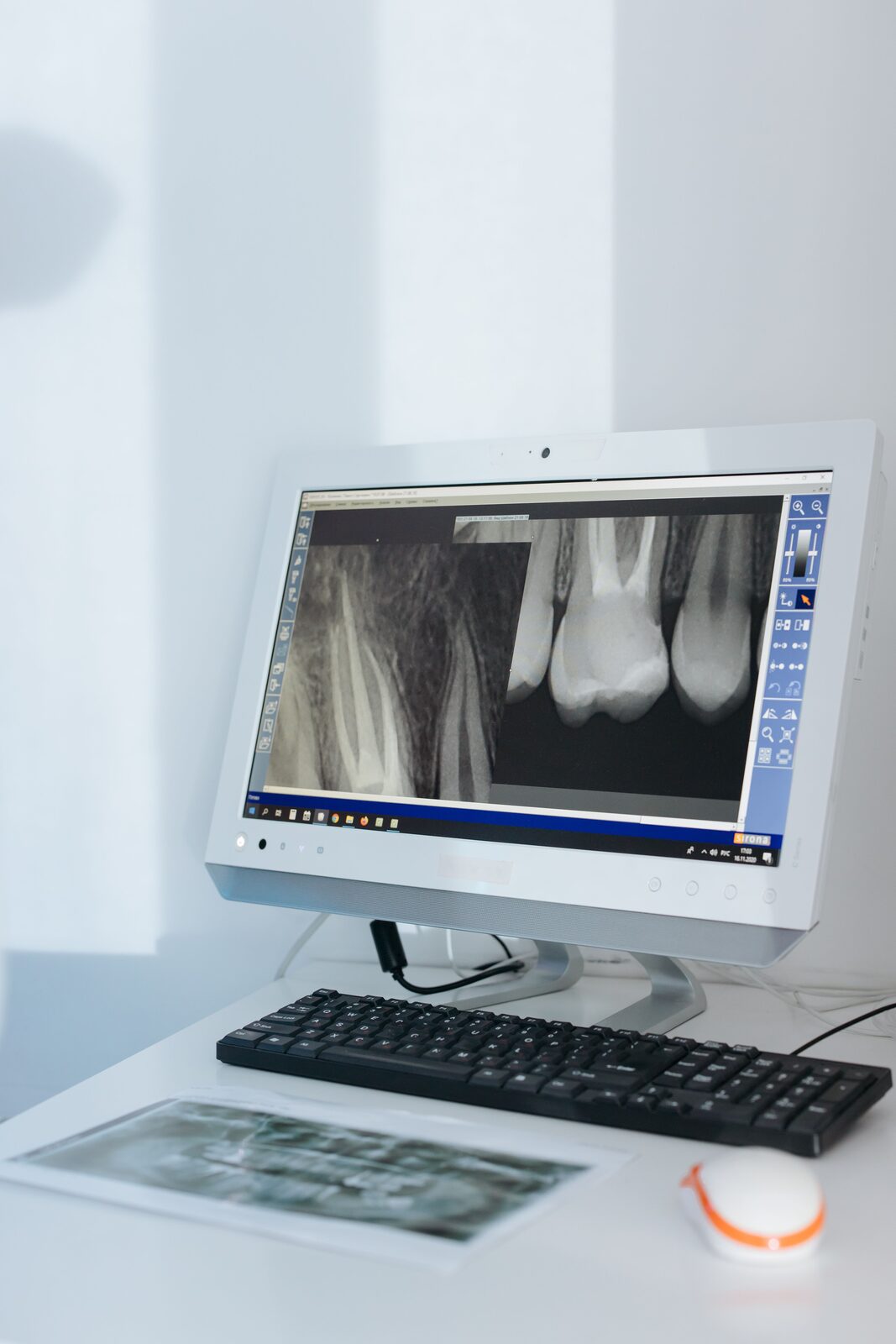 Radiographie dentaire affichée à l'écran, utilisée pour diagnostiquer une lésion périapicale