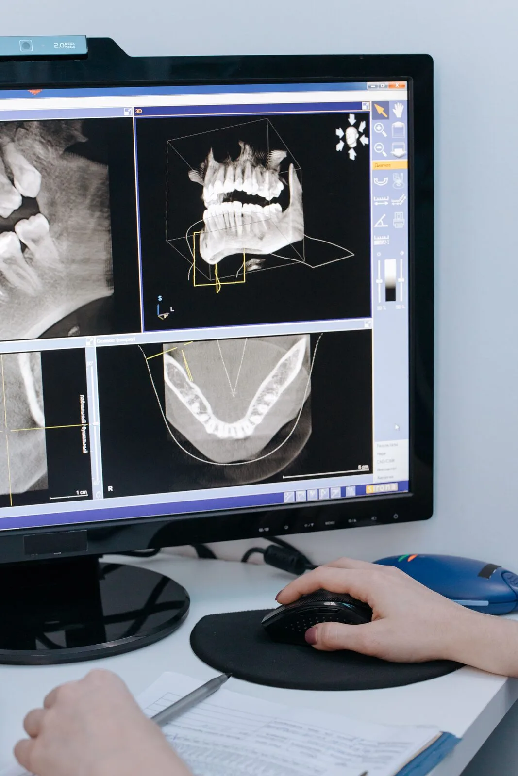 Radiographie dentaire permettant d'évaluer la profondeur d'une carie