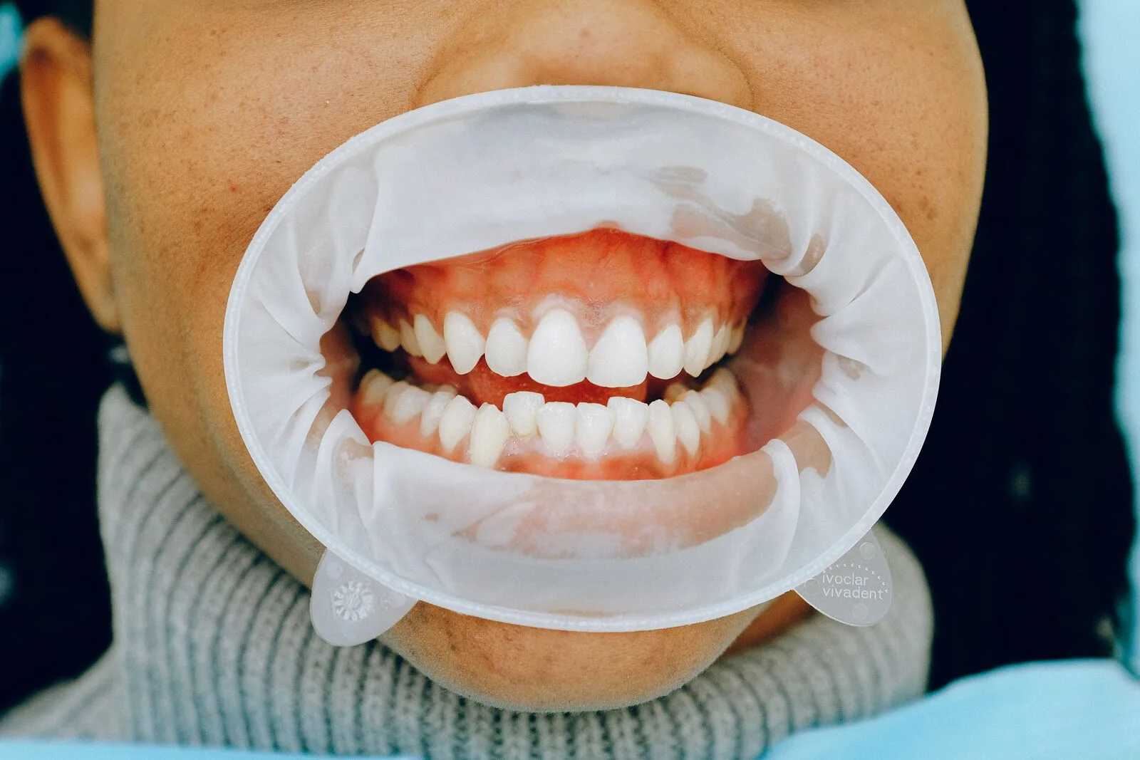 Récession gingivale exposant la dentine radiculaire, cause fréquente de sensibilité au froid