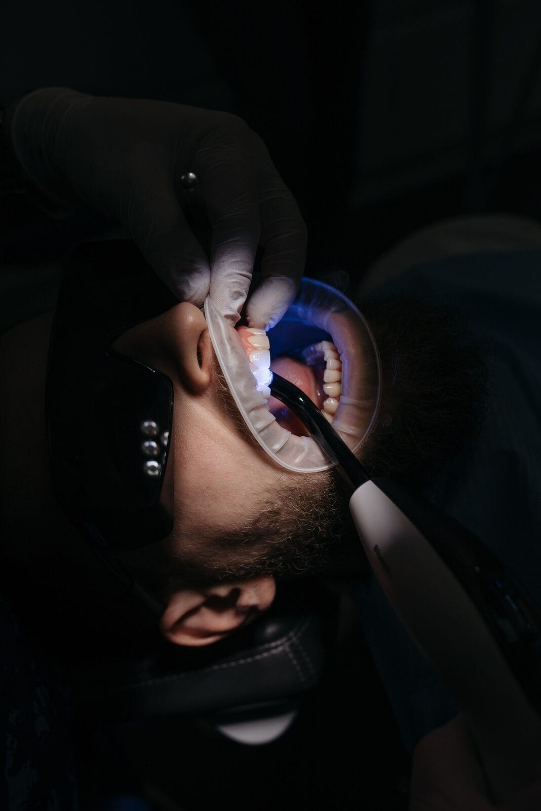 Biodentine et MTA, biomatériaux modernes pour le coiffage pulpaire
