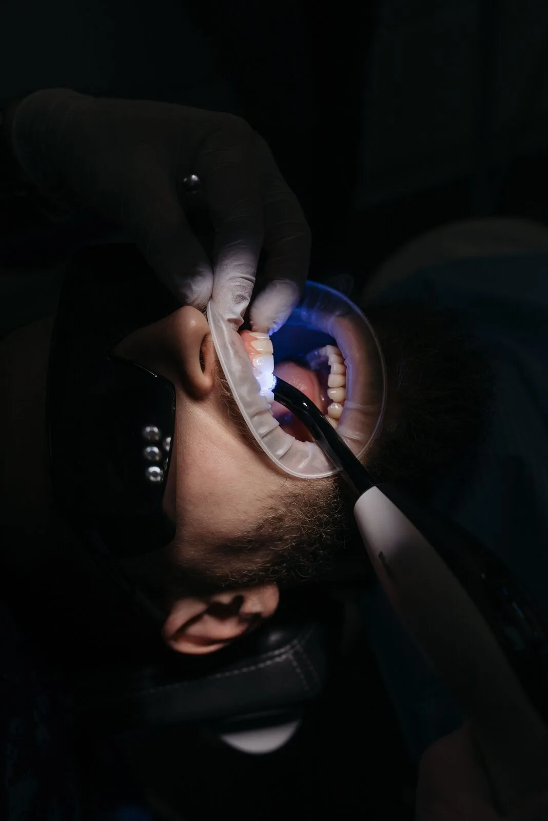 Biodentine et MTA, biomatériaux modernes pour le coiffage pulpaire